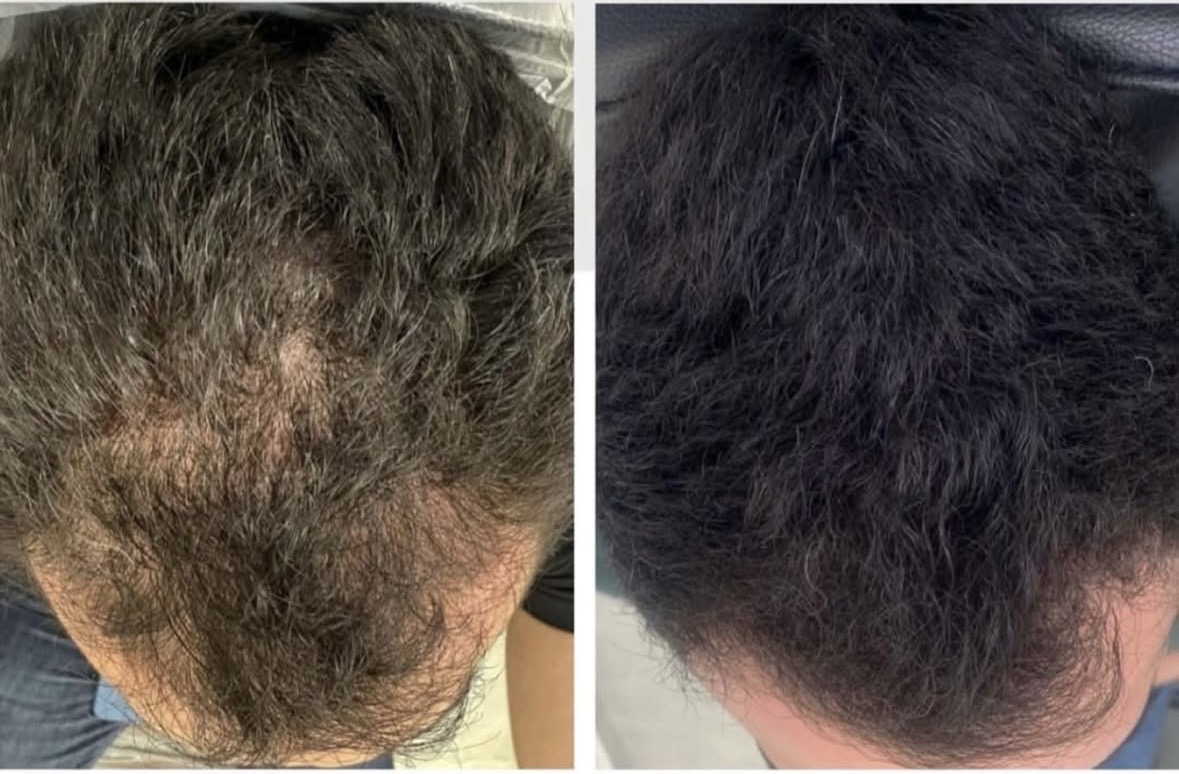 hair exosomes for hair loss, encouraging hair growth, paired with microneedling