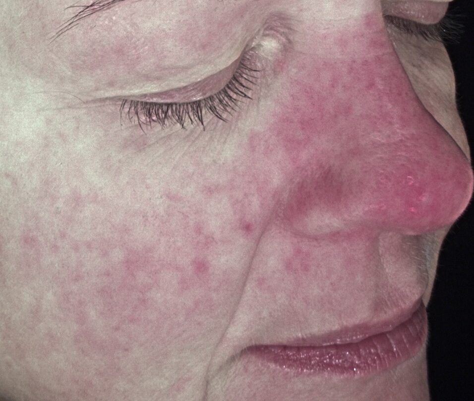 client sensitivity and redness at SKIN lounge Aesthetics Richmond Hill client sensitivity and redness at SKIN lounge Aesthetics Richmond Hill