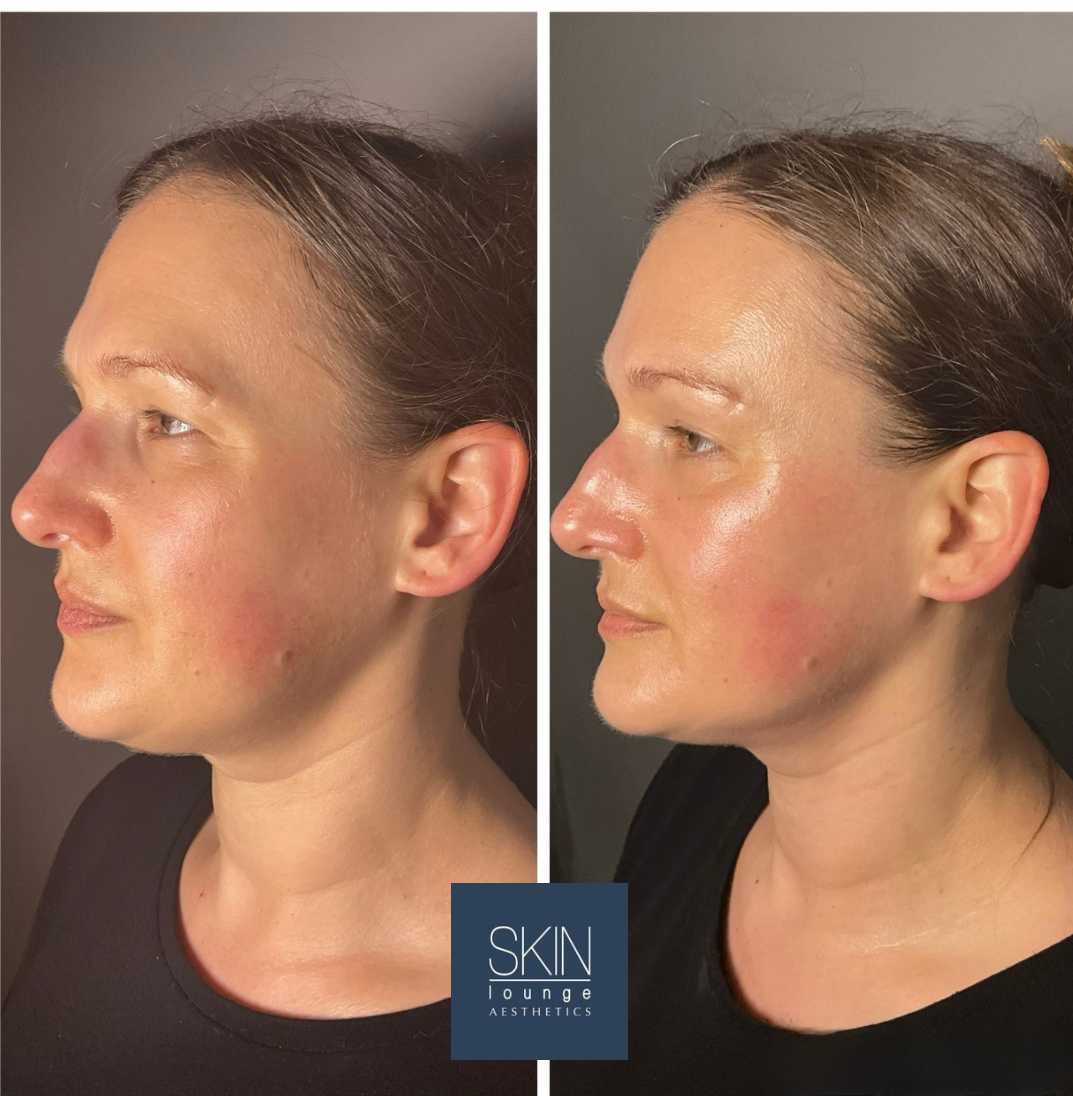 Before and after pictures from HydraLift Deluxe involving HIFU, ClearLift and Dermalux LED at SKIN lounge Aesthetics Richmond, London
