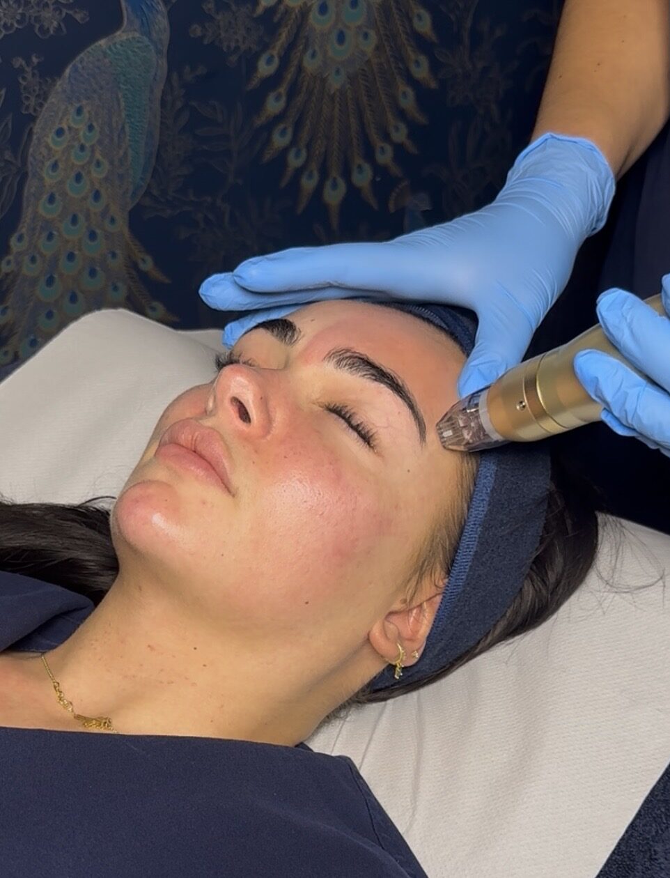 Sylfirm RF Microneedling at SKIN lounge Aesthetics Richmond London Sylfirm RF Microneedling at SKIN lounge Aesthetics Richmond London