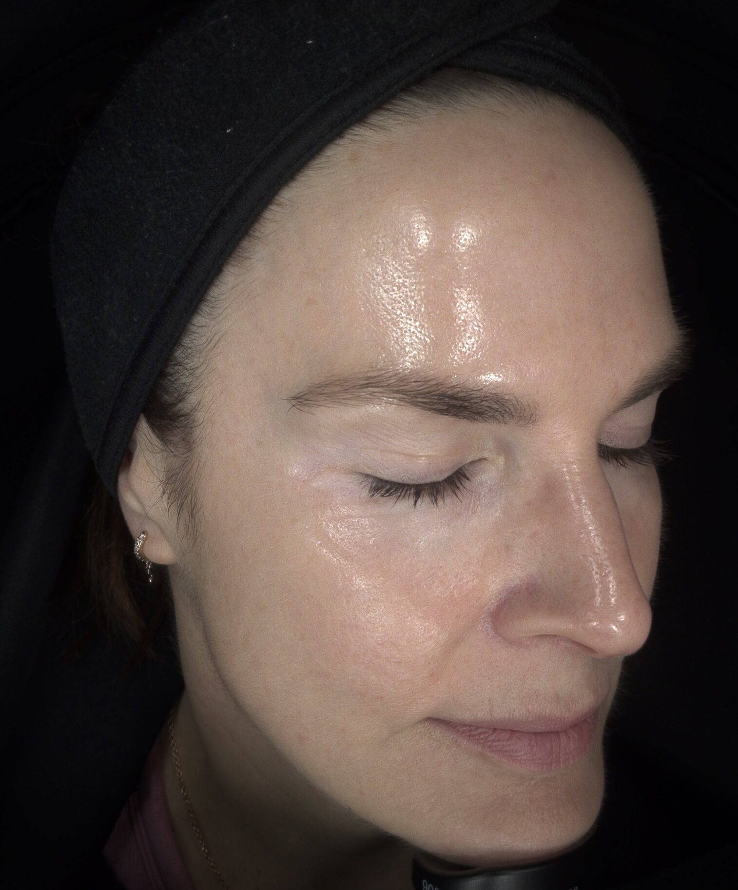 beautiful clear, healthy skin after regular treatments at SKIN lounge Aesthetics Richmond London